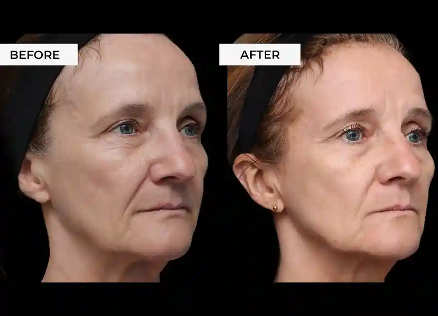 How Many RF Microneedling Sessions Will You Need to See a Difference Marlow?