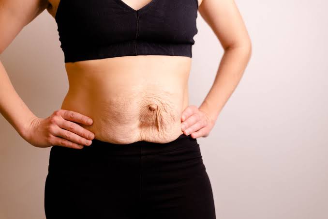Is Surgery Really the Only Way to Repair Diastasis Recti Marlow?