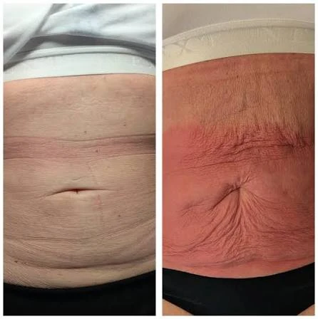 How Does RF Microneedling Improve Crepey, Thin and Uneven Skin Texture Marlow?