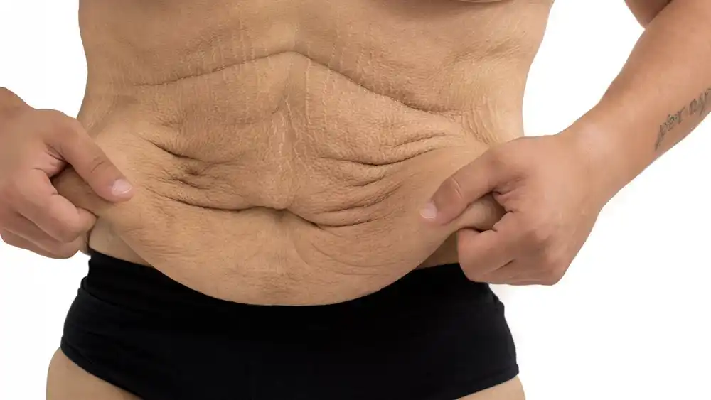 Why Does Weight Loss Medication Leave Some People With Loose or Sagging Skin Marlow?